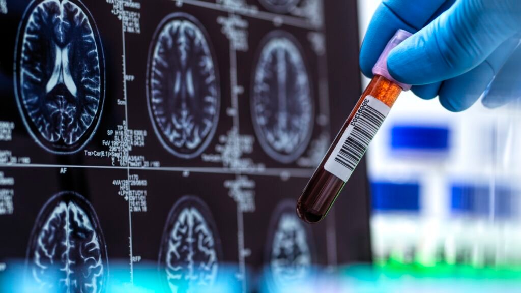 First FDA-cleared Alzheimer’s blood test set to boost diagnoses' speed, accuracy : Shots