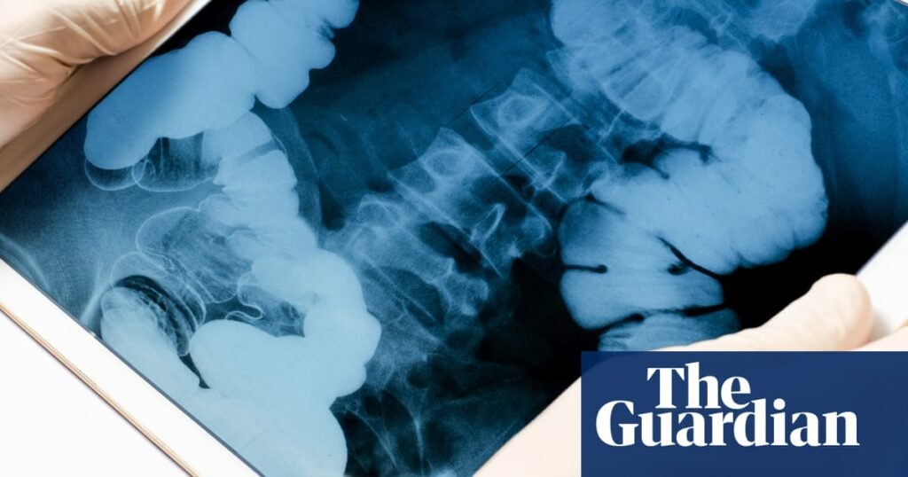 The ick factor that could save a life: US cancer researchers look to fecal waste for treatment clues | US news The ick factor that could save a life: US cancer researchers look to fecal waste for treatment clues | US news