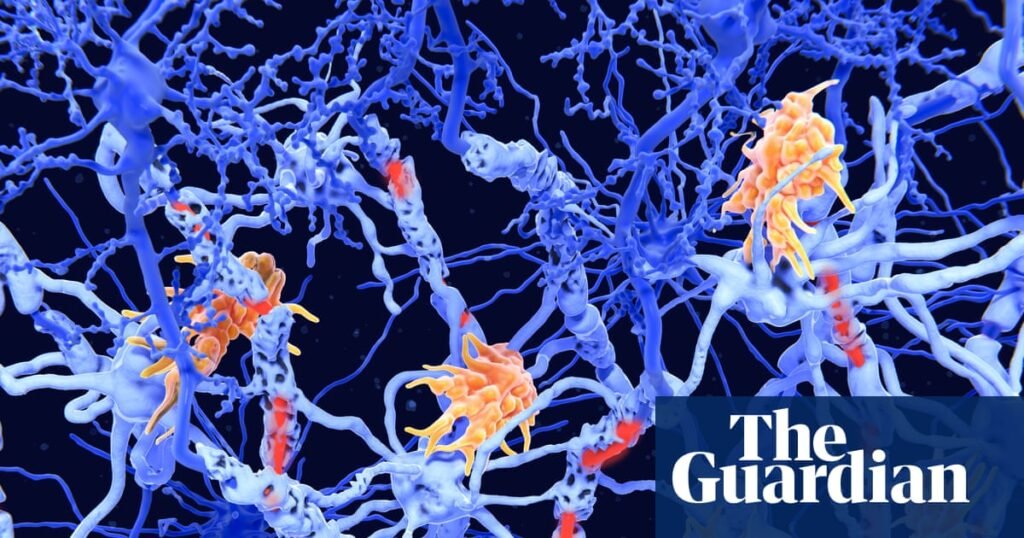 ‘Exciting’ clinical results offer hope for new class of MS therapies | Multiple sclerosis